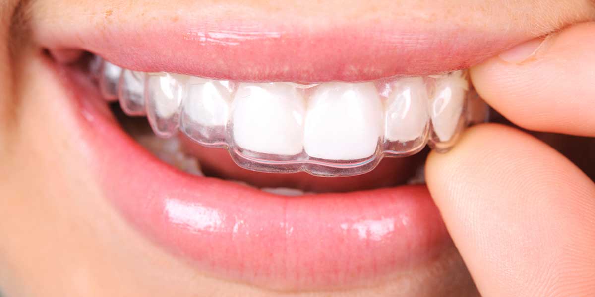 Invisalign® clear aligner